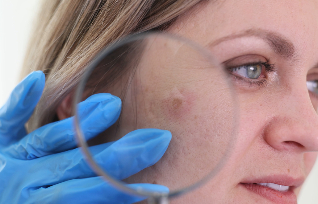 KI erleichtert Hautvorsorge